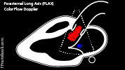 PLAX_color_flow_doppler.png