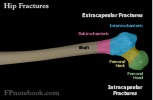 hipFractureRegions.jpg