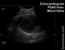 ultrasoundBMP_cvPSAX_MV2.jpg