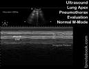 ultrasoundBMP_lungPtxEvalMModeWNL.jpg